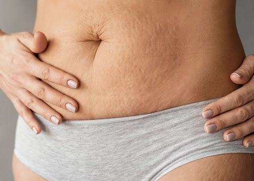 Stretch mark saat hamil: Cegah dan Atasi dengan Cara Ini!