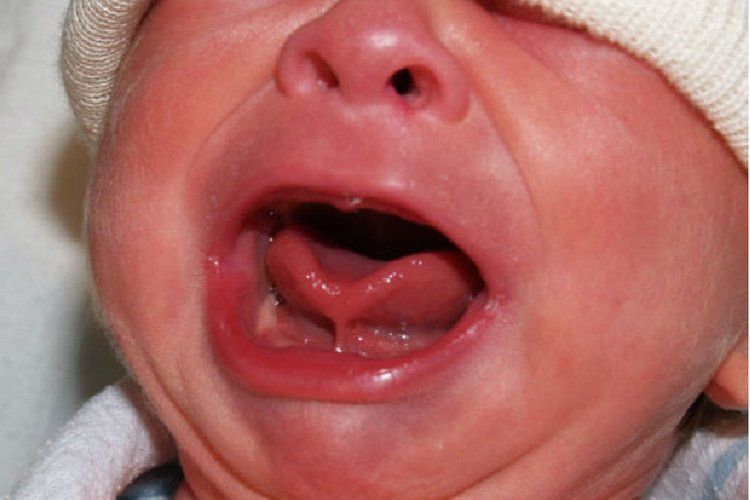 Tounge Tie? Apa Itu dan Cara Menaganinya